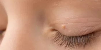 Eyelid Bump (Lesion) Removal