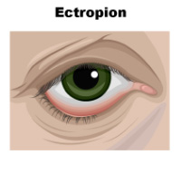 Figure Demonstrating Entropion