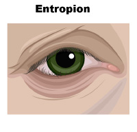 Figure Demonstrating Entropion