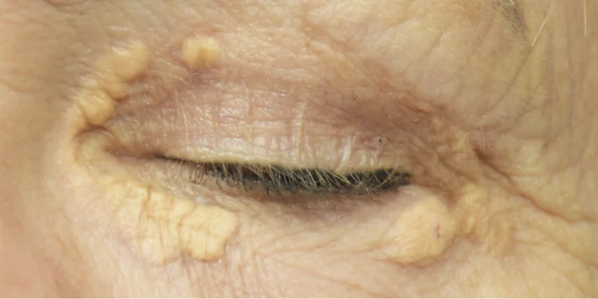 Image of left upper and lower eyelid showing yellowish xanthelasma bumps